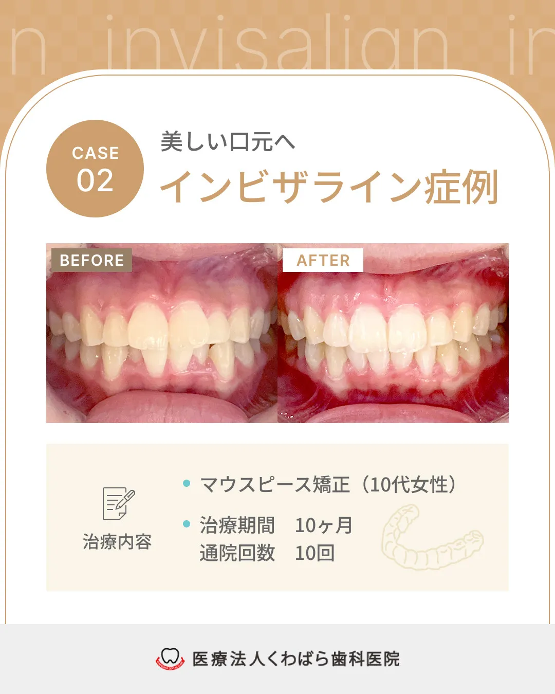 【インビザライン症例紹介】